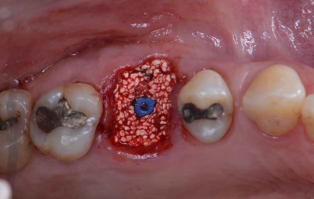 Caso 23 10 - Implante imediato e cicatrizador personalizado para manutenção do contorno tecidual em região molar 10 | Preenchimento do alvéolo fresco com biomaterial substituto ósseo de origem sintética. Destaque para o Tapa Implante colocado para prevenir a entrada do biomaterial dentro do implante