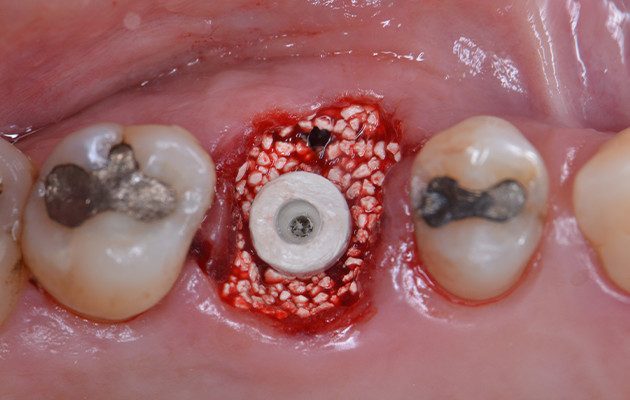 Caso 23 11 - Implante imediato e cicatrizador personalizado para manutenção do contorno tecidual em região molar 11 | Cicatrizador Multifuncional Arcsys posicionado sobre o implante.