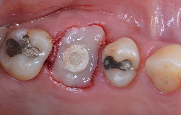 Caso 23 12 - Implante imediato e cicatrizador personalizado para manutenção do contorno tecidual em região molar 12 | Resina composta fluida unida ao Cicatrizador se estendo até as margens do tecido mole para manter o contorno tecidual durante o período de osseointegração do Implante.