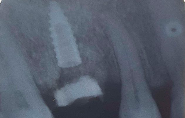 Caso 23 13 - Implante imediato e cicatrizador personalizado para manutenção do contorno tecidual em região molar 13 | Radiografia periapical realizada logo após a instalação do Implante com Cicatrizador personalizado.
