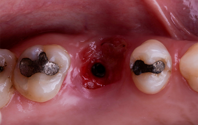 Caso 23 14 - Implante imediato e cicatrizador personalizado para manutenção do contorno tecidual em região molar 14 | Aspecto dos tecidos moles depois da remoção do Cicatrizador, três meses após a cirurgia de instalação do Implante.