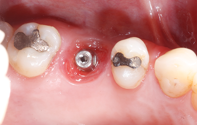 Caso 23 16 - Implante imediato e cicatrizador personalizado para manutenção do contorno tecidual em região molar 16 | Aspecto do tecido mole após o condicionamento tecidual.
