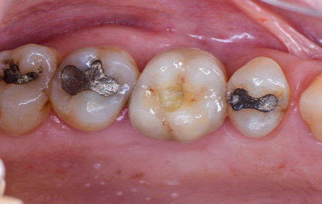 Caso 23 18 - Implante imediato e cicatrizador personalizado para manutenção do contorno tecidual em região molar 18 | Vista oclusal durante o controle de seis meses após carga protética