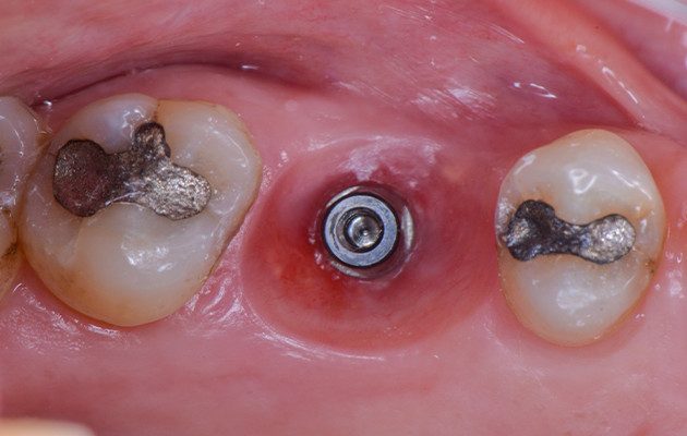 Caso 23 19 - Implante imediato e cicatrizador personalizado para manutenção do contorno tecidual em região molar 19 | Aspecto tecidual após a remoção da coroa. Destaque para a evidente saúde dos tecidos moles periimplantares.