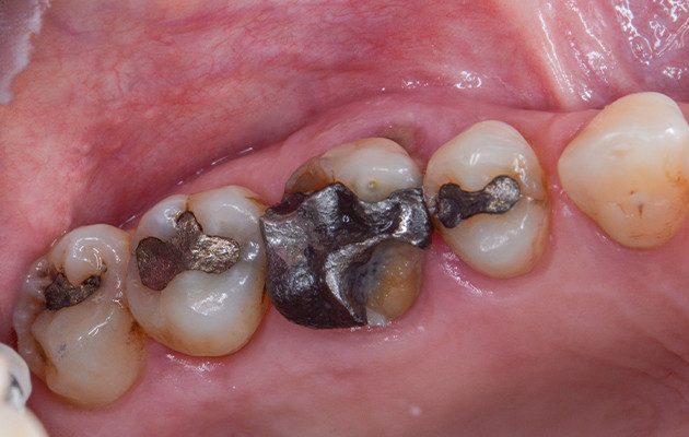 Caso 23 2 - Implante imediato e cicatrizador personalizado para manutenção do contorno tecidual em região molar 2 | Vista da superfície oclusal do dente 16. Nota-se a fratura das cúspides do dente, a restauração em amálgama de grande extensão, o acúmulo de biofilme e a presença de cárie abaixo da restauração.