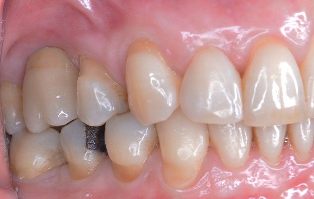 Caso 23 20 - Implante imediato e cicatrizador personalizado para manutenção do contorno tecidual em região molar 20 | Aspecto final.