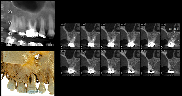 Caso 23 3 - Implante imediato e cicatrizador personalizado para manutenção do contorno tecidual em região molar 3 | Exame tomográfico da região do dente 16.