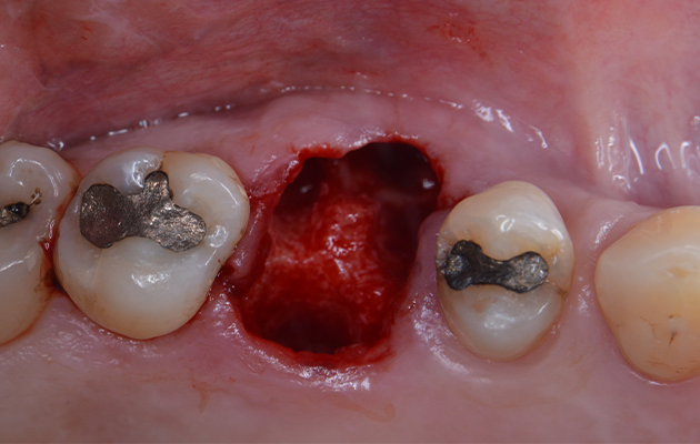 Caso 23 4 - Implante imediato e cicatrizador personalizado para manutenção do contorno tecidual em região molar 4 | Vista oclusal mostrando o septo ósseo interradicular preservado após a exodontia