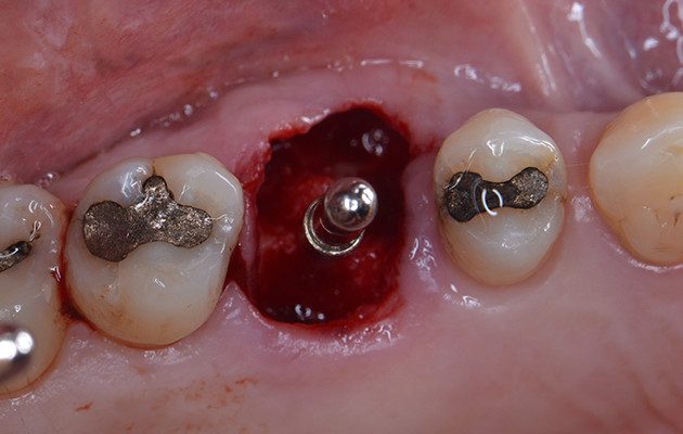 Caso 23 5 - Implante imediato e cicatrizador personalizado para manutenção do contorno tecidual em região molar 5 | Instalação do Paralelizador evidenciando o bom posicionamento da fresagem para a instalação do Implante