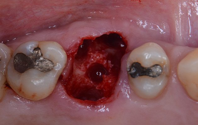 Caso 23 6 - Implante imediato e cicatrizador personalizado para manutenção do contorno tecidual em região molar 6 | Aspecto do leito cirúrgico após protocolo de fresagem.