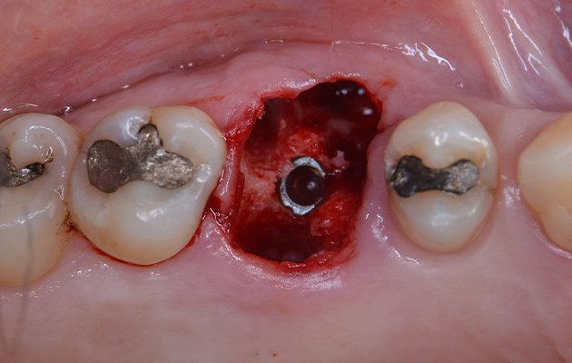 Caso 23 9 - Implante imediato e cicatrizador personalizado para manutenção do contorno tecidual em região molar 9 | Posição do Implante ao final da instalação.