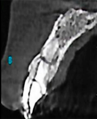 1 e 2 | Tomografia e aspecto clínico do elemento 21, demonstrando fratura radicular com escurecimento. Condições pré-operatórias do caso. Procedimento cirúrgico realizado em 2017.