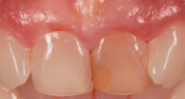 1 e 2 | Tomografia e aspecto clínico do elemento 21, demonstrando fratura radicular com escurecimento. Condições pré-operatórias do caso. Procedimento cirúrgico realizado em 2017.