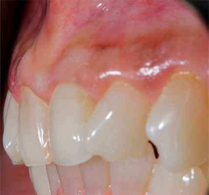 3 e 4 | Acompanhamento clínico de implante imediato, preenchimento do gap com Nanosynt e estética imediata no elemento 21. Após 7,5 anos, observa-se ausência de recessão, presença de papila e manutenção do volume tecidual peri-implantar.