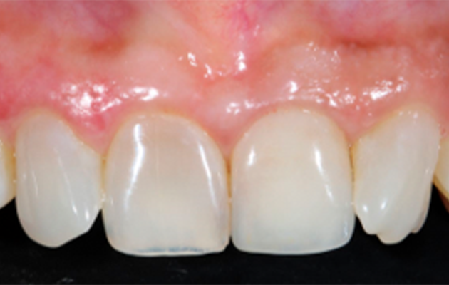 3 e 4 | Acompanhamento clínico de implante imediato, preenchimento do gap com Nanosynt e estética imediata no elemento 21. Após 7,5 anos, observa-se ausência de recessão, presença de papila e manutenção do volume tecidual peri-implantar.