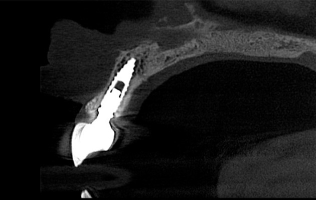 5 e 6 | Acompanhamento tomográfico de 7,5 anos. Observa-se no corte transversal a estabilidade de tábua óssea vestibular reconstruída com Nanosynt de partícula de 500 a 1000 mm e no corte coronal, a migração do tecido ósseo ao redor do componente protético comprovando a estabilidade da conexão entre implante e componente.