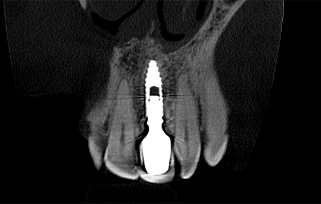 5 e 6 | Acompanhamento tomográfico de 7,5 anos. Observa-se no corte transversal a estabilidade de tábua óssea vestibular reconstruída com Nanosynt de partícula de 500 a 1000 mm e no corte coronal, a migração do tecido ósseo ao redor do componente protético comprovando a estabilidade da conexão entre implante e componente.