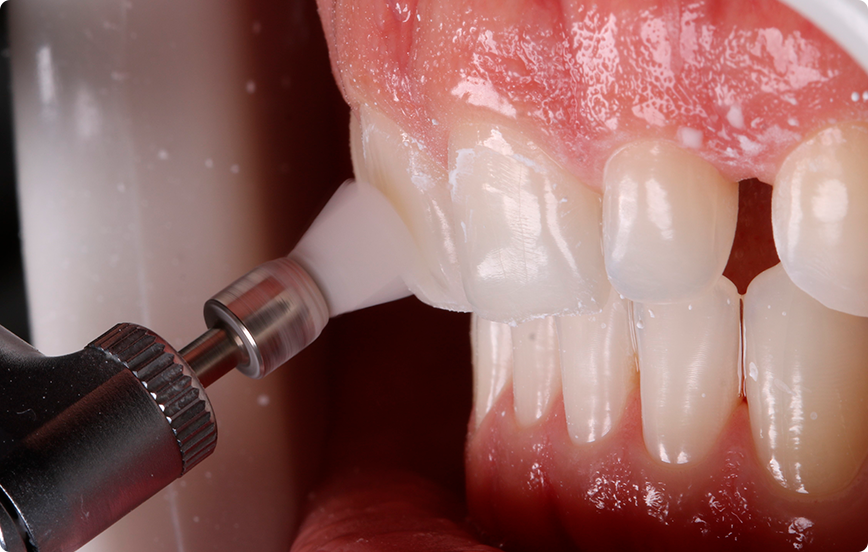 2 | Profilaxia com pedra-pomes e água.