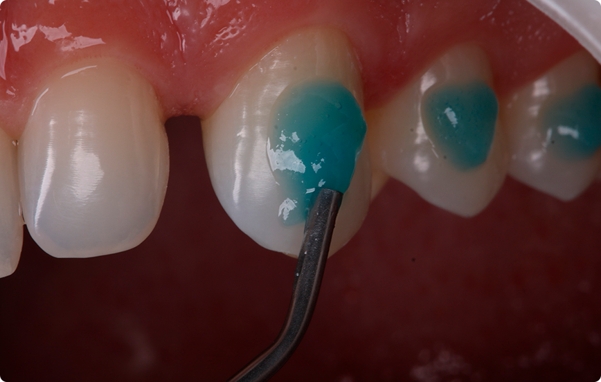 3 | Condicionamento ácido com Condac 37.