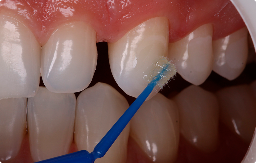 5 | Aplicação do primer adesivo Ambar APS Ortho com Cavibrush.