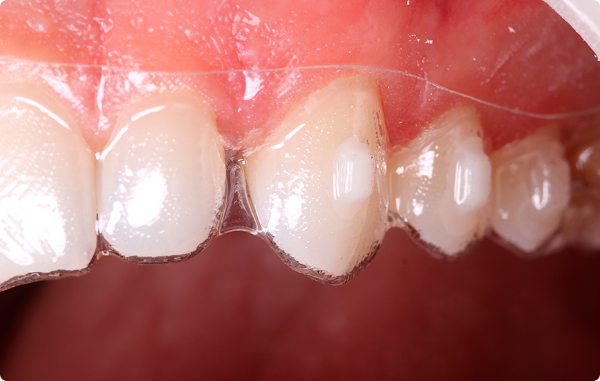 8 | Adaptação do template em boca.