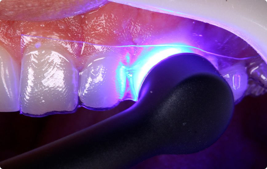 9 | Fotoativação da resina composta com o Quazar.