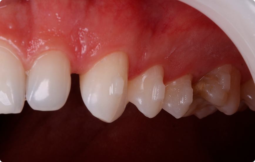 10 | Aspecto após fotoativação da resina.