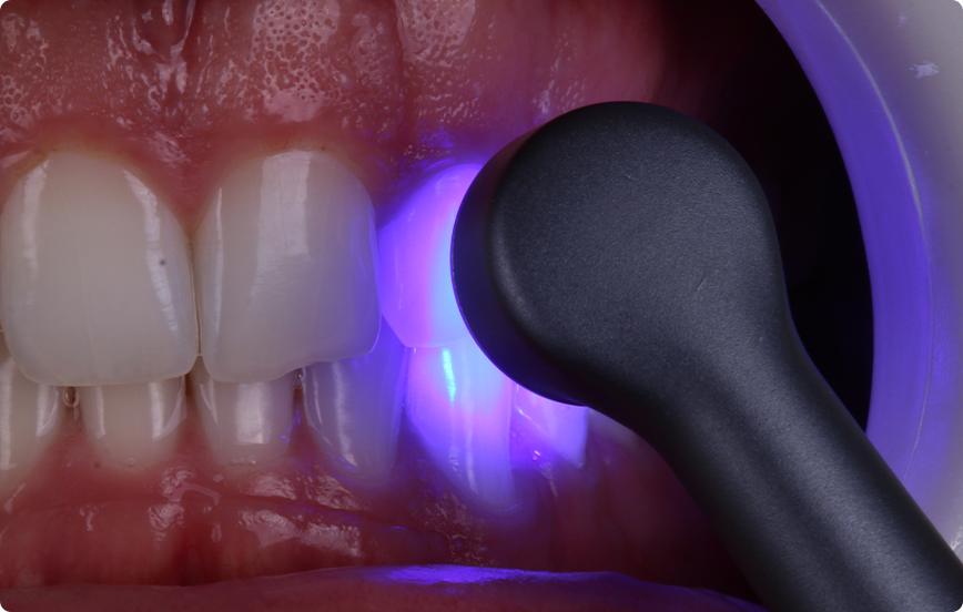 6 | Fotoativação do primer adesivo por apenas 3 segundos, com Quazar, modo Ortho.