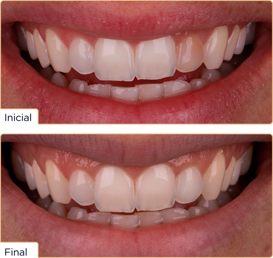 Caso whiteness25 Cesar - Concurso Whiteness