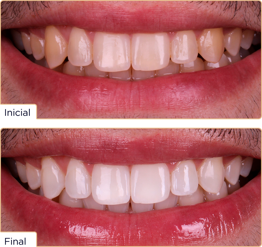 Caso whiteness25 Jessica - Concurso Whiteness