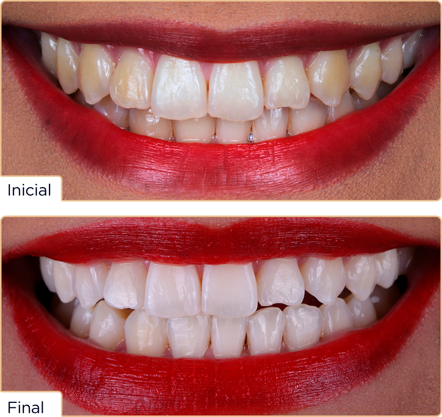 Caso whiteness25 Nicole - Concurso Whiteness