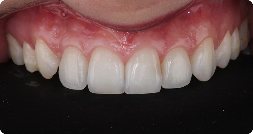 caso alana vittra 1 1 - Vittra APS - Resina compuesta premium