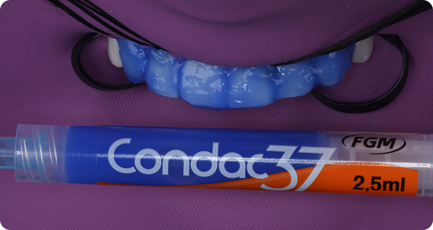 caso alana vittra 2 1 - Vittra APS - Resina compuesta premium