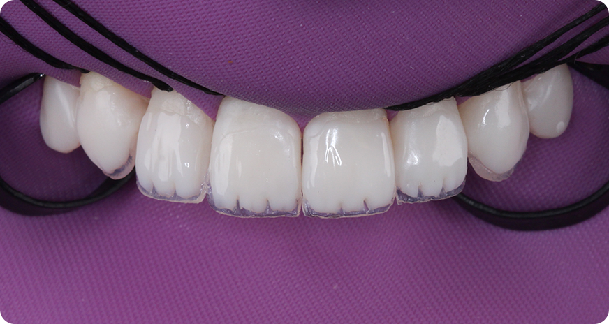 caso alana vittra 4 1 - Vittra APS - Resina compuesta premium