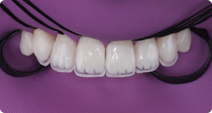 caso alana vittra 5 1 - Vittra APS - Resina compuesta premium