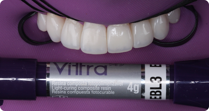 caso alana vittra 6 1 - Vittra APS - Resina compuesta premium