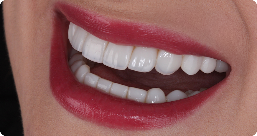 caso alana vittra 7 1 - Vittra APS - Resina compuesta premium