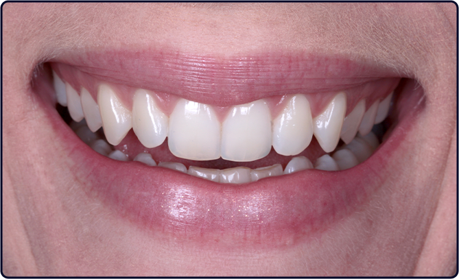 caso hp blue 1 antes - Kit Whiteness 30 Anos