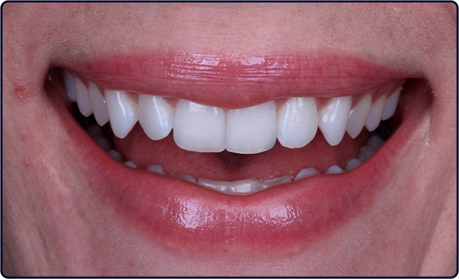 caso hp blue 1 depois - Kit Whiteness 30 Anos