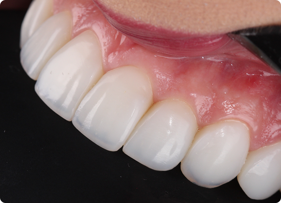 img dente vittra aps 4 1 - Vittra APS - Resina compuesta premium