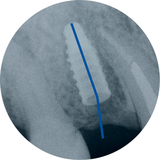 arcsys implante instalado 1 - Sistema de Implantes Arcsys