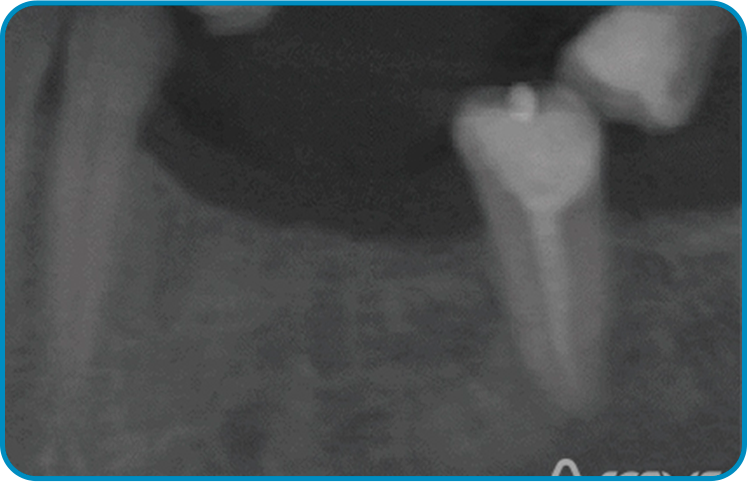 caso arcsys 1 - Sistema de Implantes Arcsys