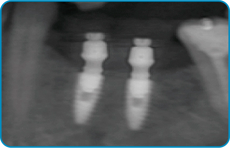 caso arcsys 2 - Sistema de Implantes Arcsys