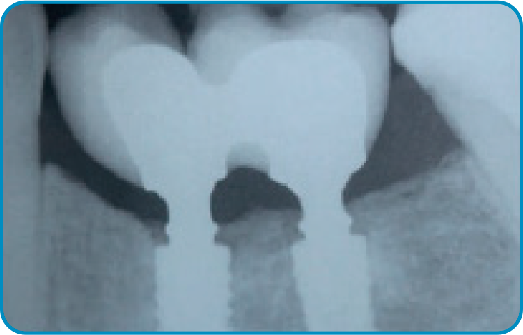 caso arcsys 3 - Sistema de Implantes Arcsys