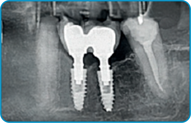 caso arcsys 4 - Sistema de Implantes Arcsys