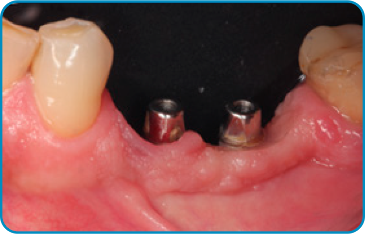 caso arcsys 6 - Sistema de Implantes Arcsys