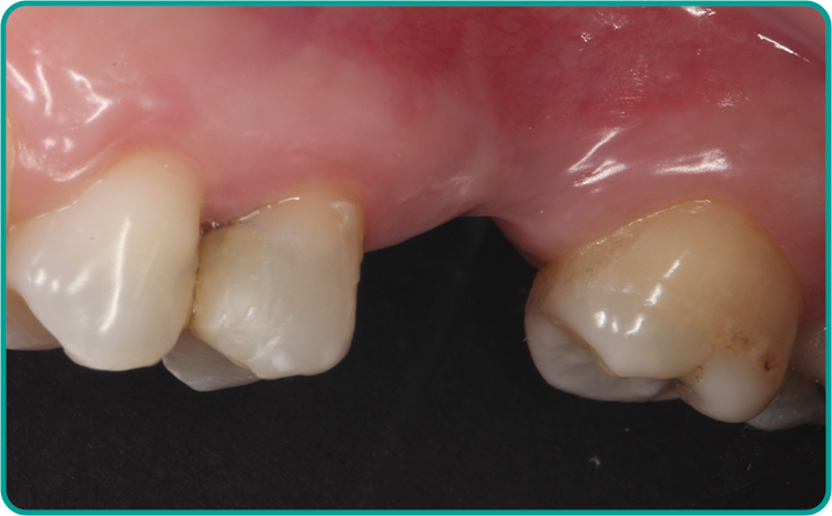caso clinico cga aikkon antes - Cirurgia Guiada Precision