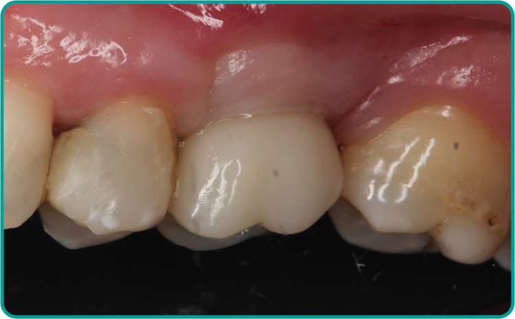 caso clinico cga aikkon depois - Cirurgia Guiada Precision