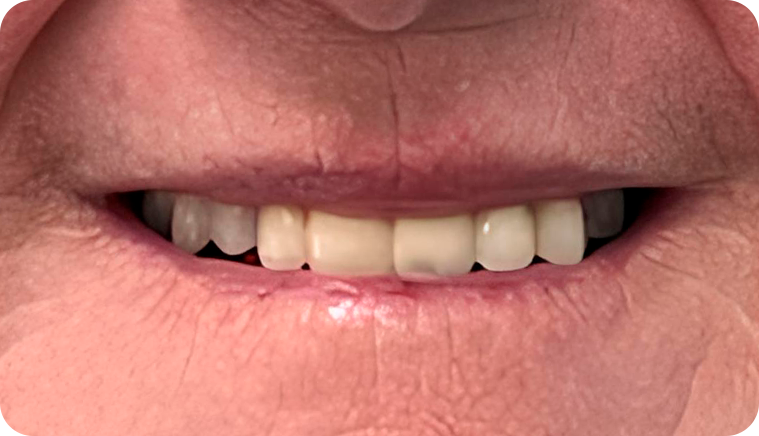 caso fiber pro 1 - Fiber Pro caso fiber pro 1 - Fiber Pro