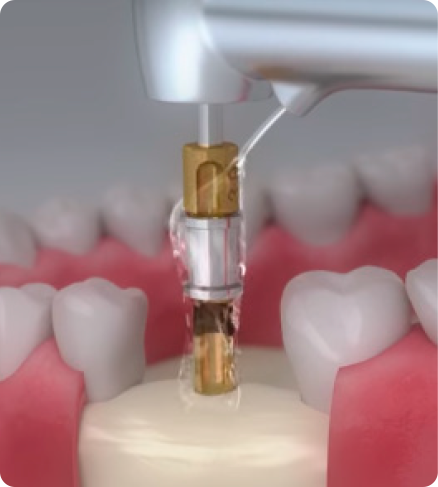 elemento arcsys 9 - Sistema de Implantes Arcsys